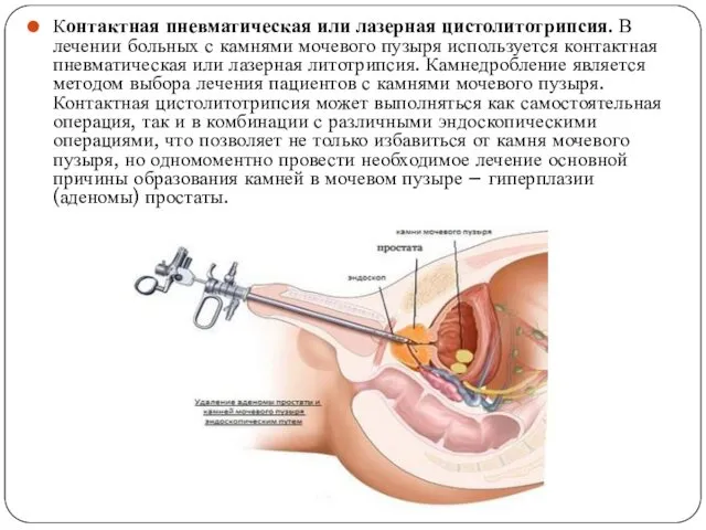 Контактная пневматическая или лазерная цистолитотрипсия. В лечении больных с камнями мочевого пузыря используется