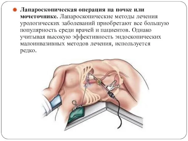 Лапароскопическая операция на почке или мочеточнике. Лапароскопические методы лечения урологических заболеваний приобретают все