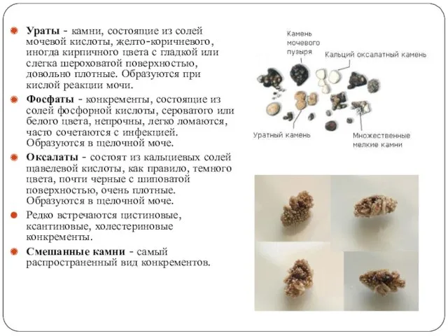 Ураты - камни, состоящие из солей мочевой кислоты, желто-коричневого, иногда