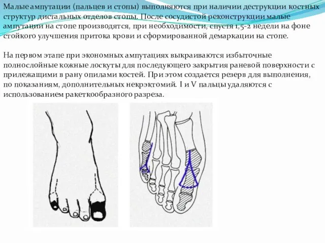 Малые ампутации (пальцев и стопы) выполняются при наличии деструкции костных