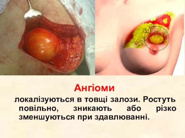 Ліпома пухлина з жирової тканини. Може локалізуватись біля молочної залози