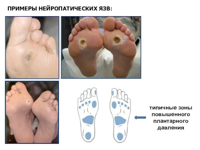ПРИМЕРЫ НЕЙРОПАТИЧЕСКИХ ЯЗВ: типичные зоны повышенного плантарного давления