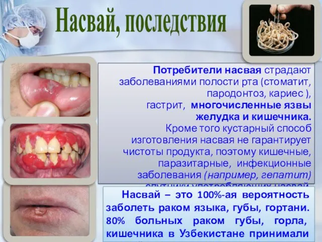 Потребители насвая страдают заболеваниями полости рта (стоматит, пародонтоз, кариес ),