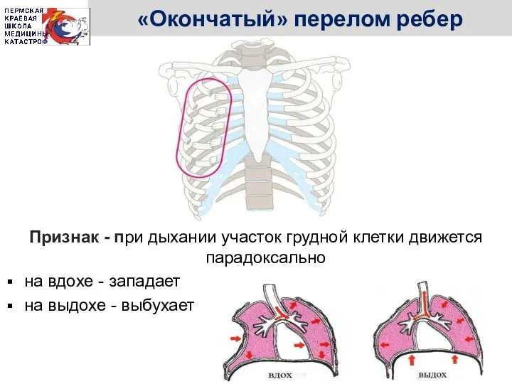 «Окончатый» перелом ребер Признак - при дыхании участок грудной клетки