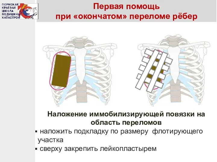 Первая помощь при «окончатом» переломе рёбер Наложение иммобилизирующей повязки на