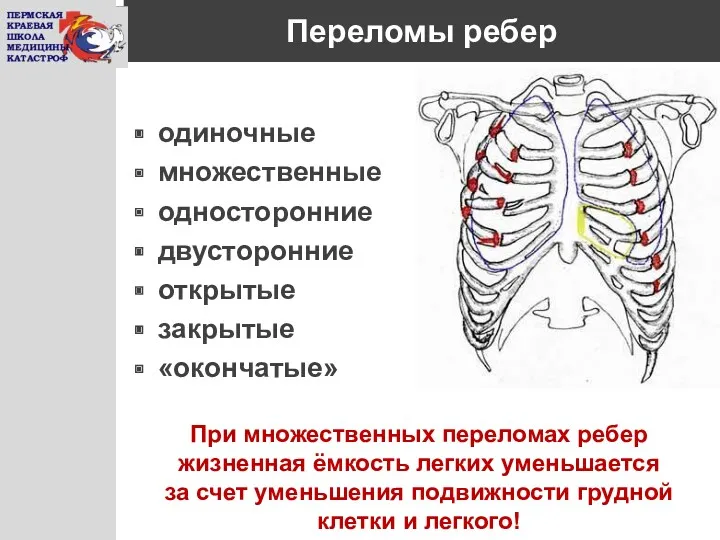 Переломы ребер одиночные множественные односторонние двусторонние открытые закрытые «окончатые» При