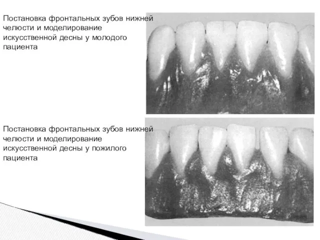 Постановка фронтальных зубов нижней челюсти и моделирование искусственной десны у