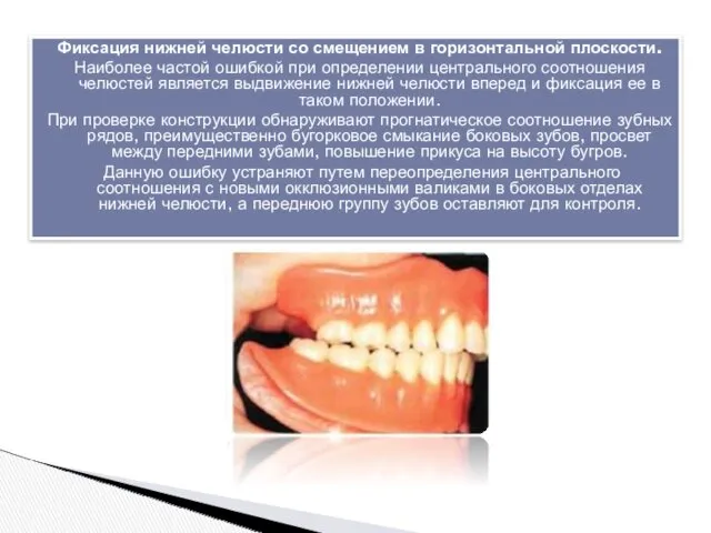 Фиксация нижней челюсти со смещением в горизонтальной плоскости. Наиболее частой