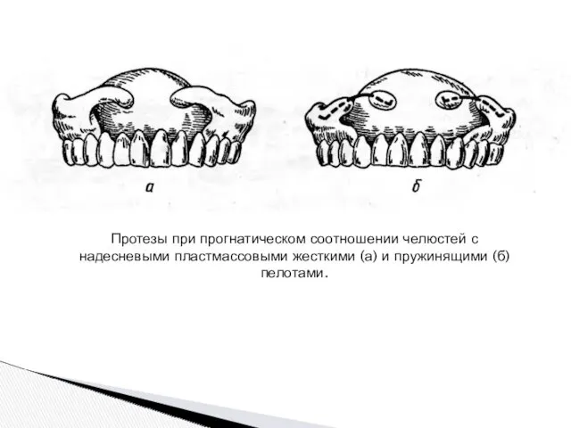 Протезы при прогнатическом соотношении челюстей с надесневыми пластмассовыми жесткими (а) и пружинящими (б) пелотами.