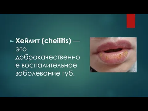 Хейлит (cheilitis) — это доброкачественное воспалительное заболевание губ.