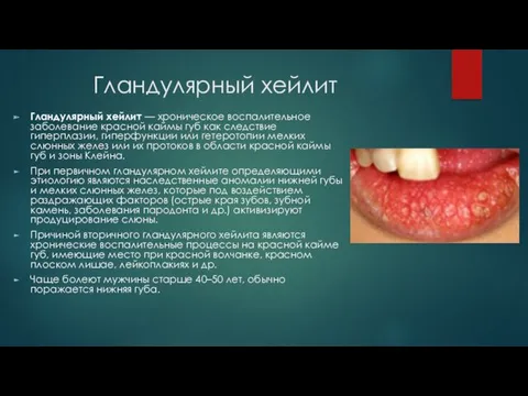 Гландулярный хейлит Гландулярный хейлит — хроническое воспалительное заболевание красной каймы
