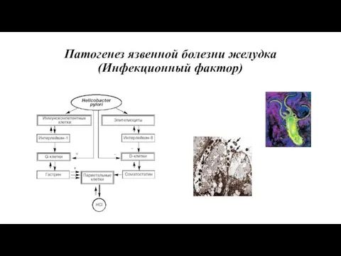 Патогенез язвенной болезни желудка (Инфекционный фактор)