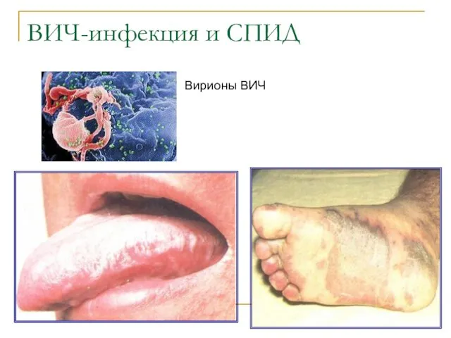 ВИЧ-инфекция и СПИД Вирионы ВИЧ