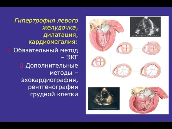 Гипертрофия левого желудочка, дилатация, кардиомегалия: Обязательный метод – ЭКГ Дополнительные методы – эхокардиография, рентгенография грудной клетки
