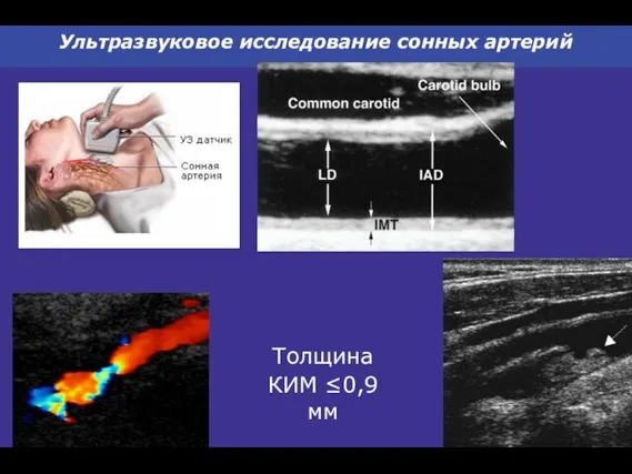 Ультразвуковое исследование сонных артерий Толщина КИМ ≤0,9 мм