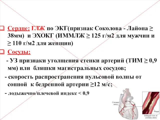 Поражение органов – мишеней (ПОМ) Сердце: ГЛЖ по ЭКГ(признак Соколова