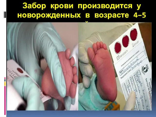Забор крови производится у новорожденных в возрасте 4–5 дней.