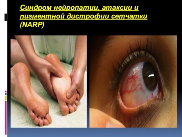Синдром нейропатии, атаксии и пигментной дистрофии сетчатки (NARP)