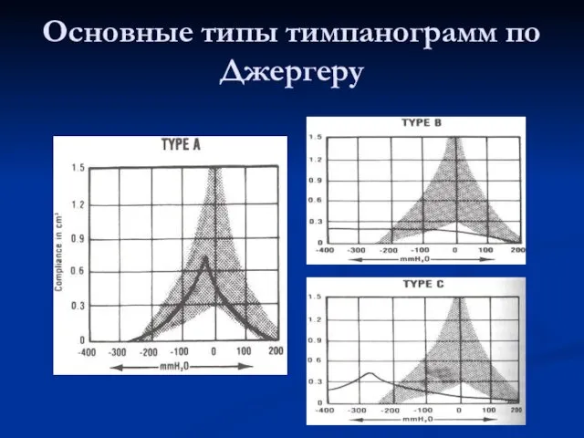 Основные типы тимпанограмм по Джергеру