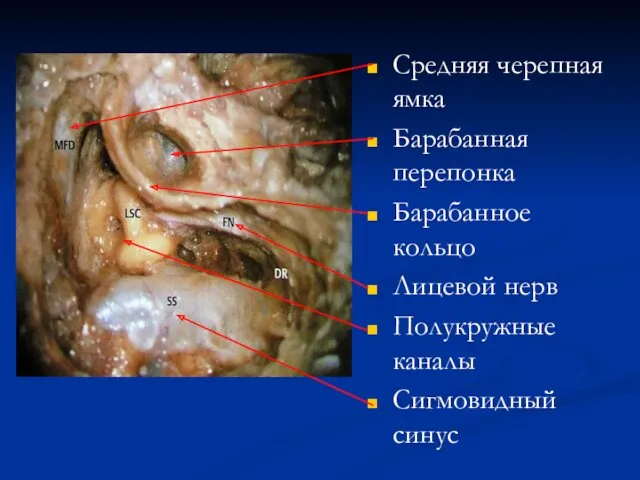Средняя черепная ямка Барабанная перепонка Барабанное кольцо Лицевой нерв Полукружные каналы Сигмовидный синус