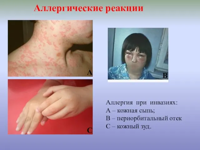 Аллергические реакции Аллергия при инвазиях: А – кожная сыпь; В