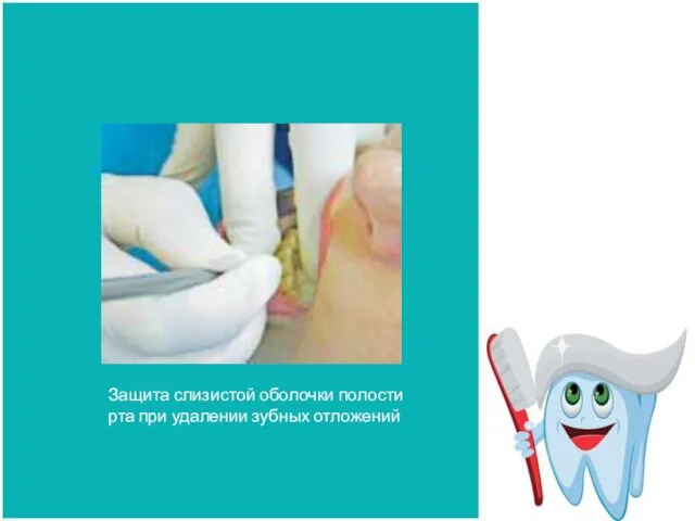 Защита слизистой оболочки полости рта при удалении зубных отложений