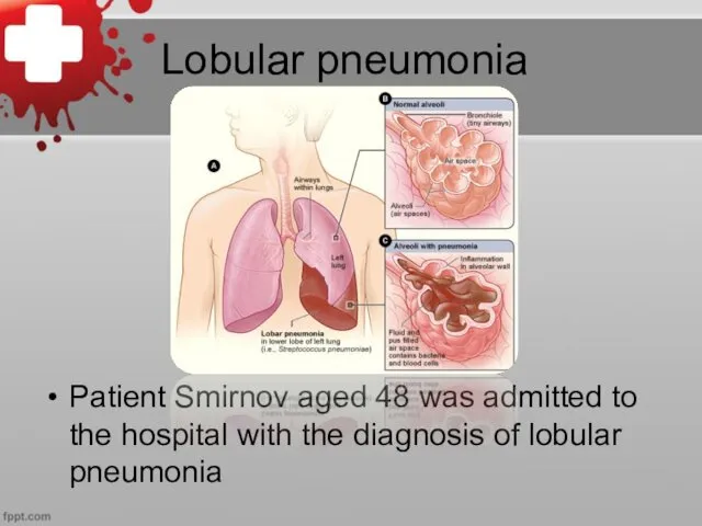 Lobular pneumonia Patient Smirnov aged 48 was admitted to the