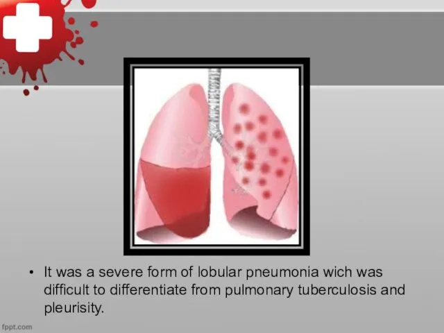 It was a severe form of lobular pneumonia wich was