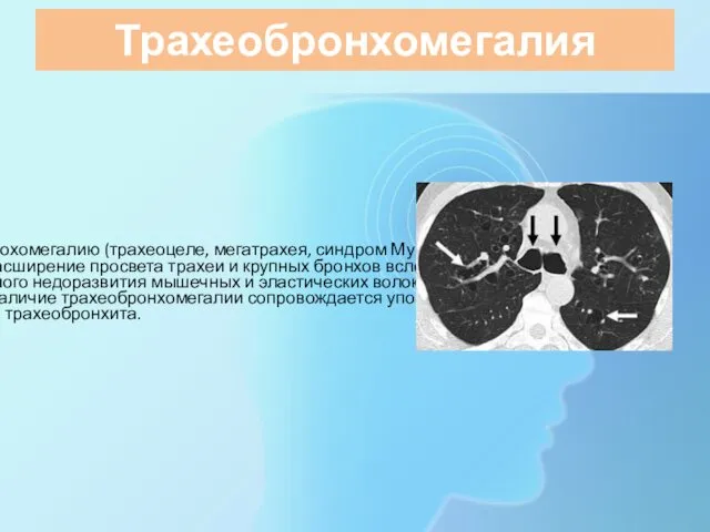 Трахеобронхомегалия Трахеоброхомегалию (трахеоцеле, мегатрахея, синдром Мунье-Куна) – расширение просвета трахеи