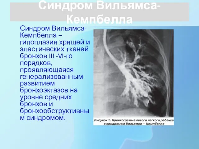 Синдром Вильямса-Кемпбелла Синдром Вильямса-Кемпбелла – гипоплазия хрящей и эластических тканей