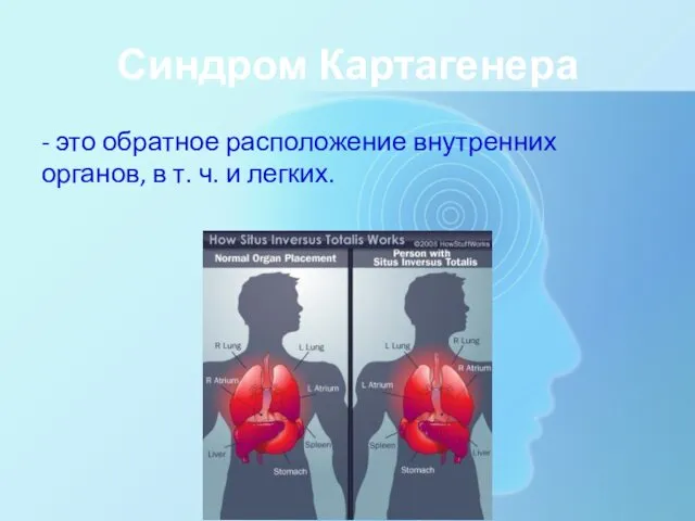 Синдром Картагенера - это обратное расположение внутренних органов, в т. ч. и легких.