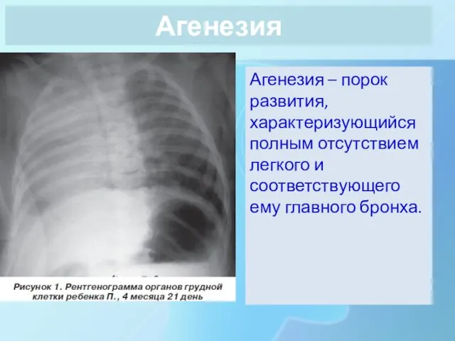 Агенезия Агенезия – порок развития, характеризующийся полным отсутствием легкого и соответствующего ему главного бронха.