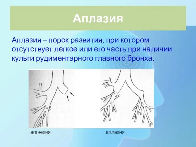 Аплазия Аплазия – порок развития, при котором отсутствует легкое или