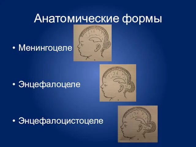 Анатомические формы Менингоцеле Энцефалоцеле Энцефалоцистоцеле