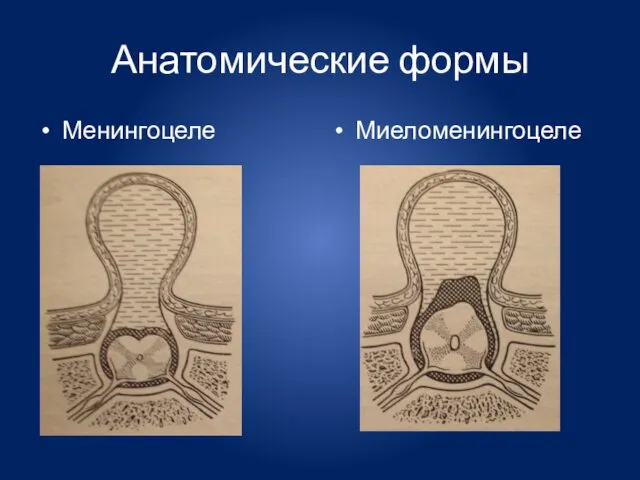 Анатомические формы Менингоцеле Миеломенингоцеле