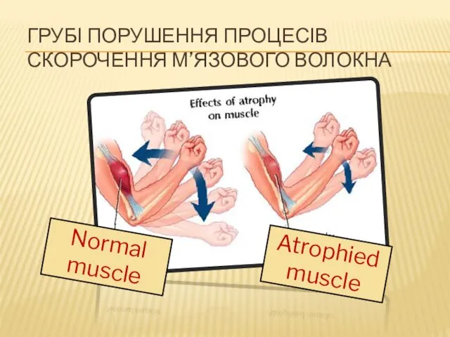 Normal muscle Atrophied muscle ГРУБІ ПОРУШЕННЯ ПРОЦЕСІВ СКОРОЧЕННЯ М’ЯЗОВОГО ВОЛОКНА