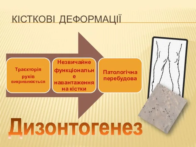 КІСТКОВІ ДЕФОРМАЦІЇ Дизонтогенез