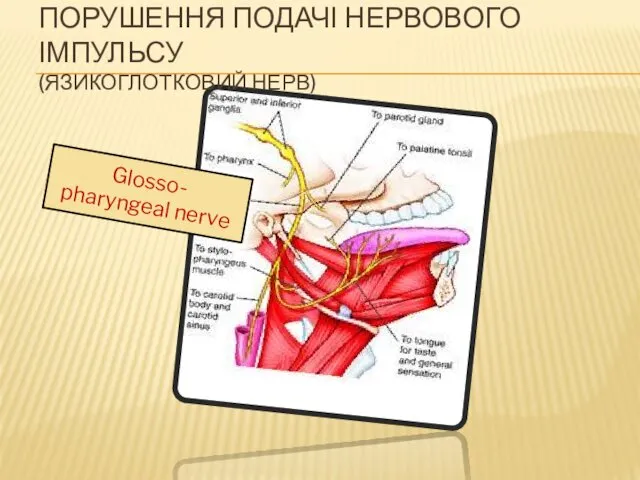 Glosso- pharyngeal nerve ПОРУШЕННЯ ПОДАЧІ НЕРВОВОГО ІМПУЛЬСУ (ЯЗИКОГЛОТКОВИЙ НЕРВ)