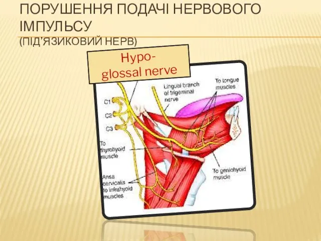 Hypo- glossal nerve ПОРУШЕННЯ ПОДАЧІ НЕРВОВОГО ІМПУЛЬСУ (ПІД’ЯЗИКОВИЙ НЕРВ)
