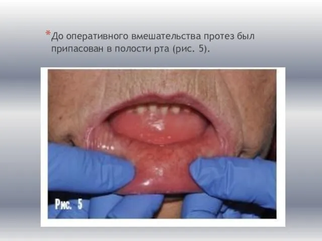 До оперативного вмешательства протез был припасован в полости рта (рис. 5).