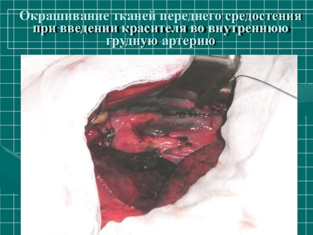 Окрашивание тканей переднего средостения при введении красителя во внутреннюю грудную артерию