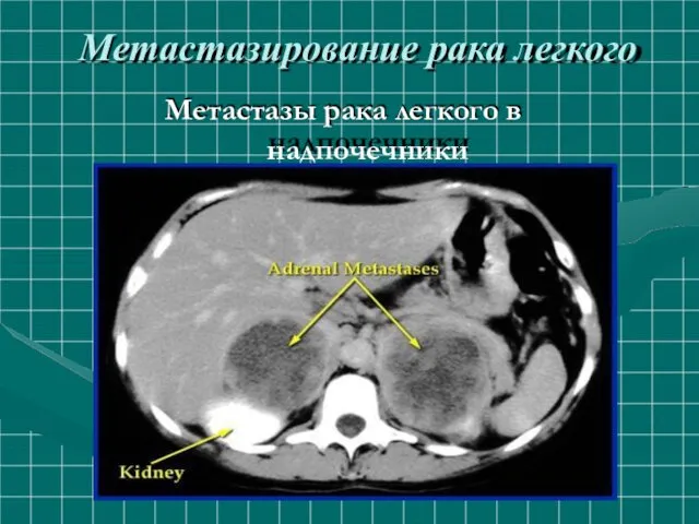 Метастазирование рака легкого Метастазы рака легкого в надпочечники