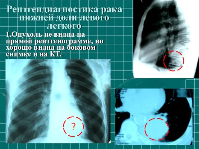 Рентгендиагностика рака нижней доли левого легкого 1.Опухoль не видна на прямой рентгенограмме, но