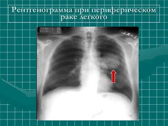 Рентгенограмма при периферическом раке легкого