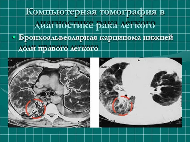 Компьютерная томография в диагностике рака легкого Бронхоальвеолярная карцинома нижней доли правого легкого