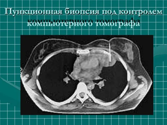 Пункционная биопсия под контролем компьютерного томографа