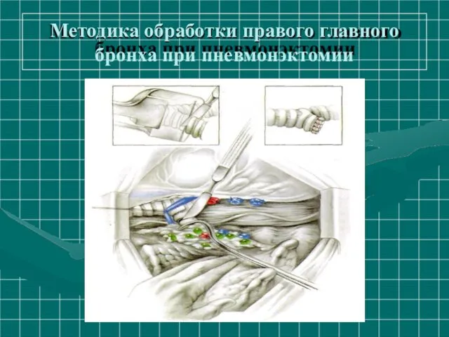 Методика обработки правого главного бронха при пневмонэктомии