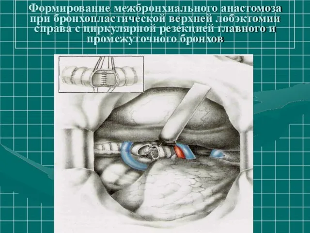 Формирование межбронхиального анастомоза при бронхопластической верхней лобэктомии справа с циркулярной резекцией главного и промежуточного бронхов