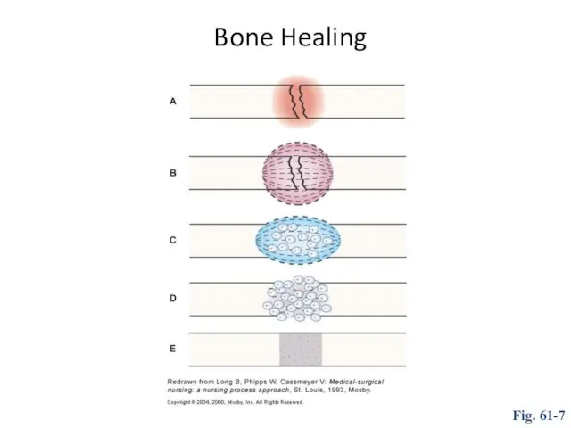 Bone Healing Fig. 61-7