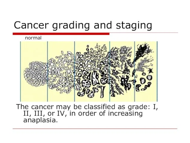 Cancer grading and staging The cancer may be classified as